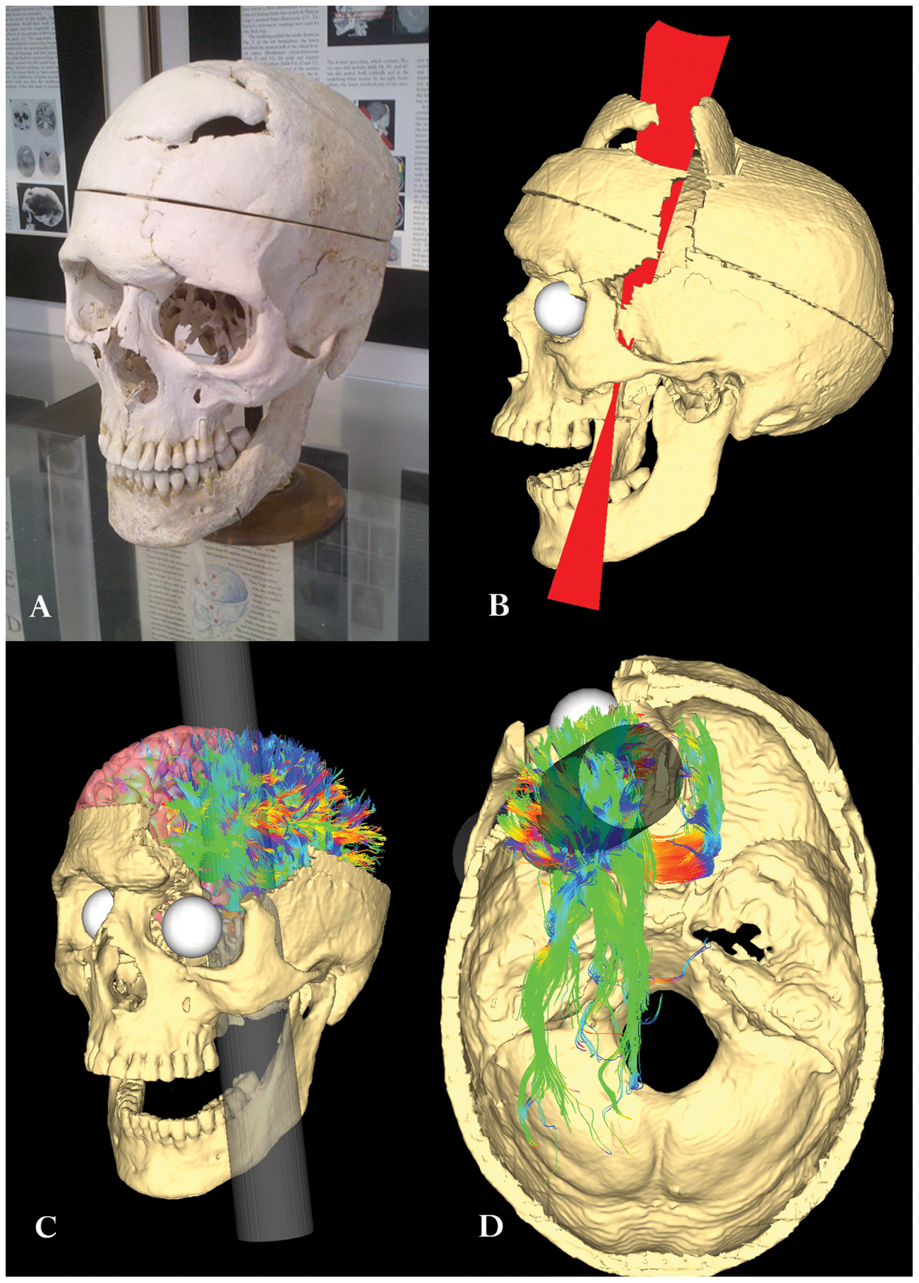 Diagram of injury to Phineas Gage