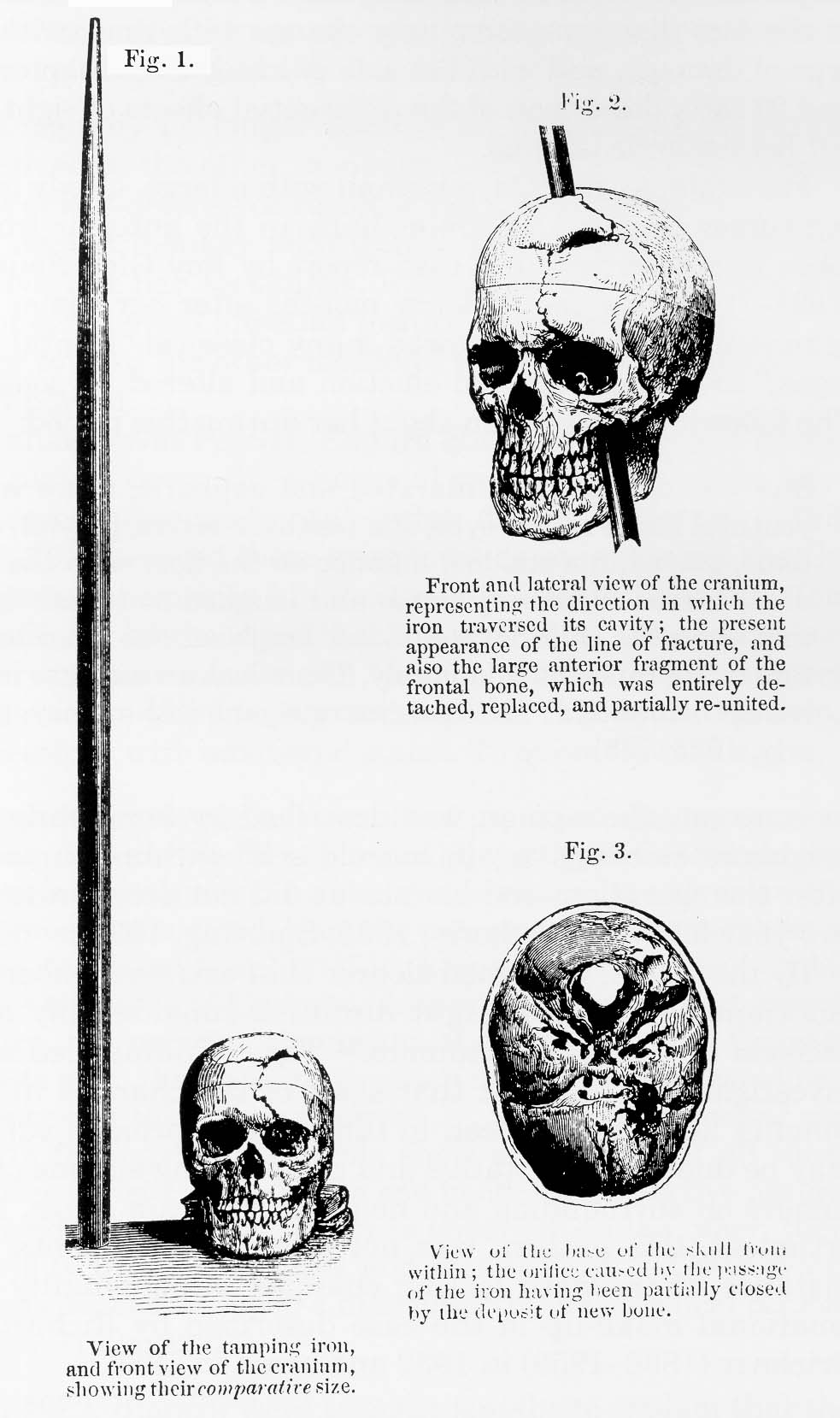 Diagram of injury to Phineas Gage