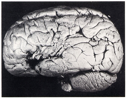 Tan lesion, view from left hemisphere